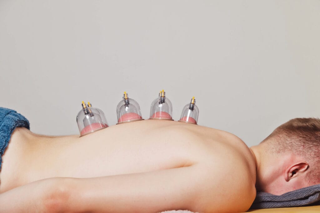 Cupping Therapy | Hudson Premier Physical Therapy & Sports | NJ