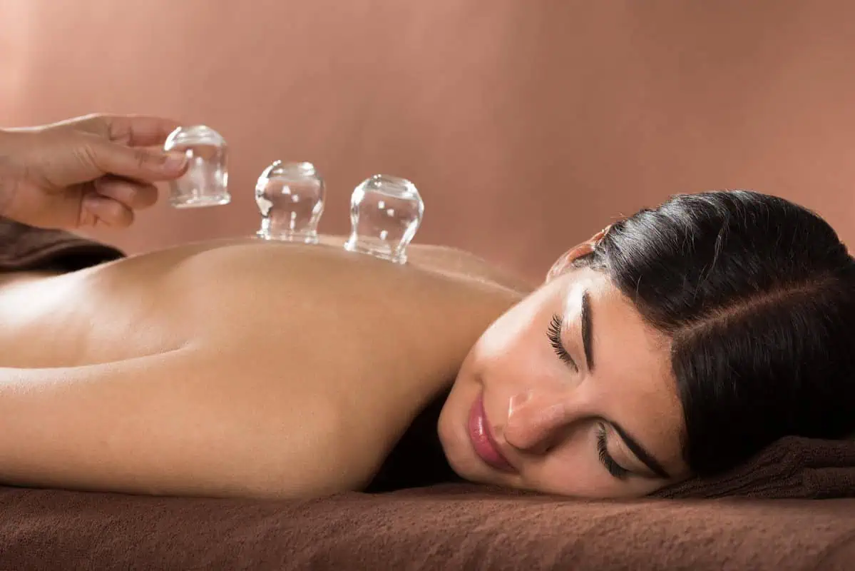 Cupping therapy by Hudson Premier PT & Sports in Union City NJ