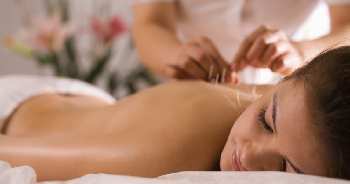 Woman receiving acupuncture treatment on her back in a spa setting in Union City, and Hoboken, NJ