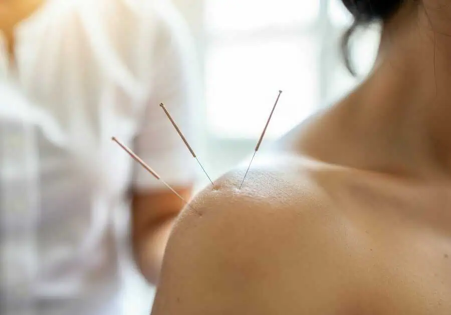 dry needling therapy on the shoulder in Union City, NJ