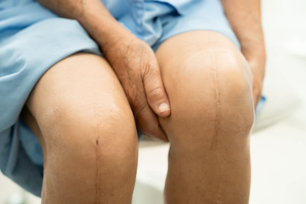 Graston Technique for reducing post-surgical knee scar tissue and improving mobility